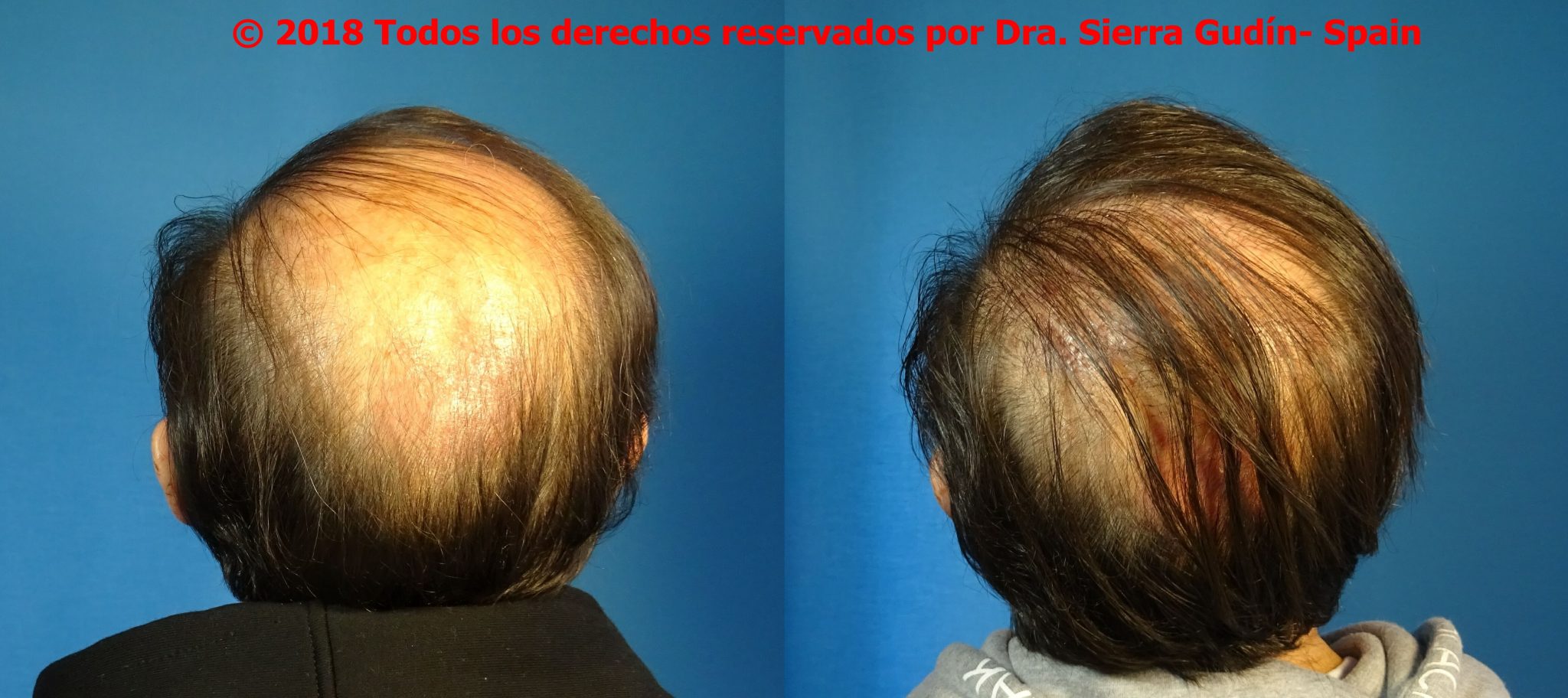 injerto capilar cadiz . Imágenes de antes y después de trasplante de pelo cadiz - dra maria jose sierra gudin - biofibre calvicie cadiz 