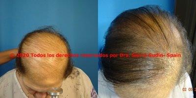 injerto capilar cadiz . Imágenes de antes y después de trasplante de pelo cadiz - dra maria jose sierra gudin - biofibre calvicie cadiz 